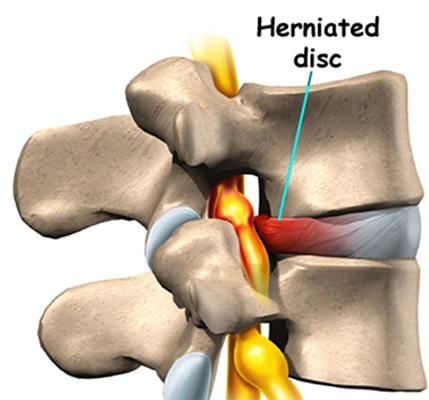 Chiropractic Mauldin SC Herniated Disc